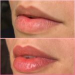 Micropigmentação labial (VIA LIP TINT)